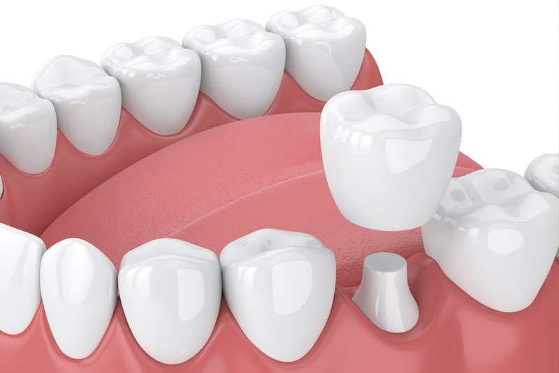 Dental Crowns in South Gate & San Fernando