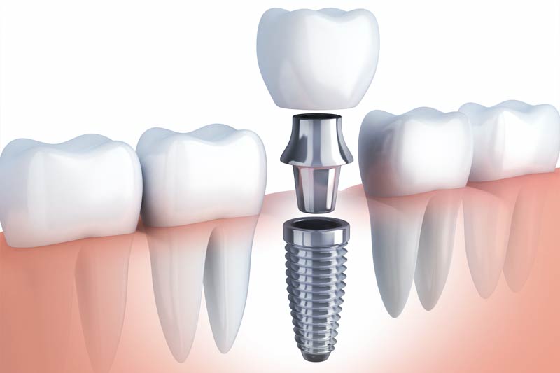 Dental Implants in San Fernando