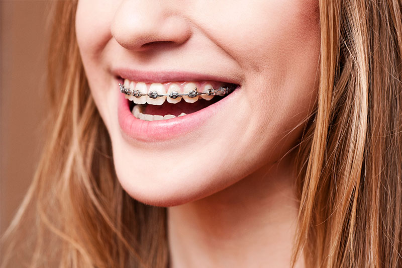 Orthodontics in South Gate & San Fernando