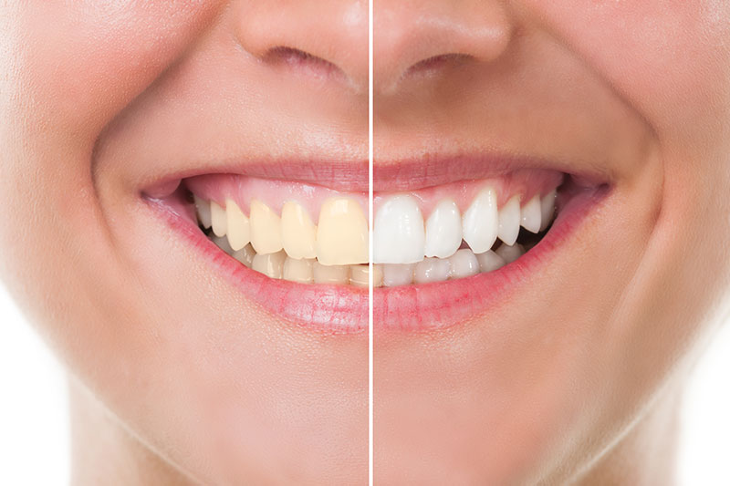 Teeth Whitening in South Gate & San Fernando
