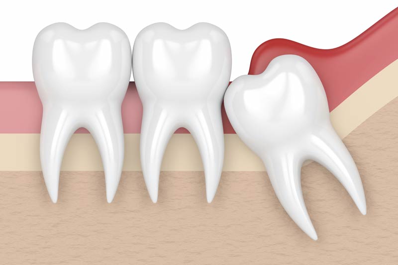 Wisdom Teeth Removal in San Fernando